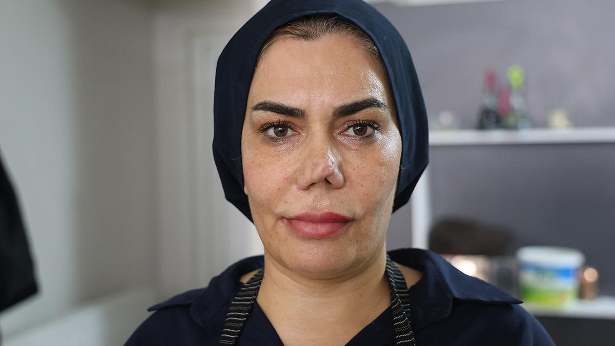Burnu Kırılması